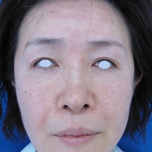 目の下のたるみ、目のくまでお悩みの方、切らずに完璧に解決します。TCB-R法　手術直後　症例写真