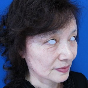目の下のたるみ、目のくまでお悩みの方、切らずに完璧に解決します。TCB-R法　手術直後　症例写真