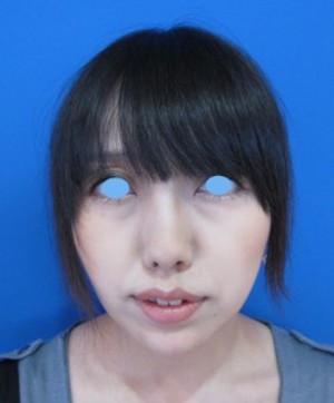 目の下のたるみ、目のくまでお悩みの方、切らずに完璧に解決します。TCB-R法　手術直後　症例写真
