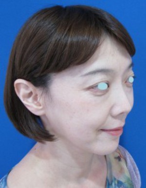 目の下のたるみ、目のくまでお悩みの方、切らずに完璧に解決します。TCB-R法　手術直後　症例写真