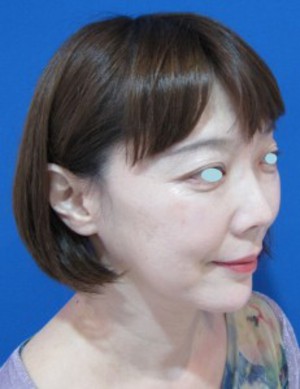 目の下のたるみ、目のくまでお悩みの方、切らずに完璧に解決します。TCB-R法　手術直後　症例写真