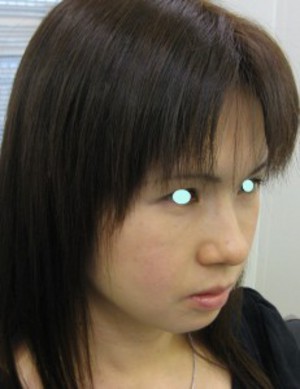 目の下のたるみ、目のくまでお悩みの方、切らずに完璧に解決します。TCB-R法　手術直後　症例写真