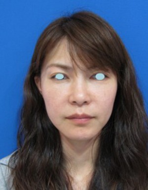 目の下のたるみ、目のくまでお悩みの方、切らずに完璧に解決します。TCB-R法　手術直後　症例写真