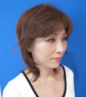 目の下のたるみ、目のくまでお悩みの方、切らずに完璧に解決します。TCB-R法　手術直後　症例写真