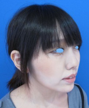 目の下のたるみ、目のくまでお悩みの方、切らずに完璧に解決します。TCB-R法　手術直後　症例写真