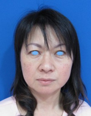 目の下のたるみ、目のくまでお悩みの方、切らずに完璧に解決します。TCB-R法　手術直後　症例写真