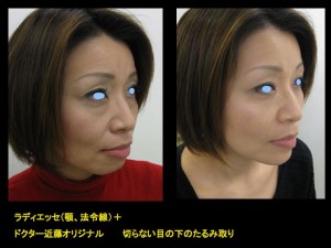 目の下のたるみ、目のくまでお悩みの方、切らずに完璧に解決します。TCB-R法　手術直後　症例写真