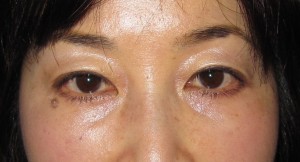 目の下のたるみ、目のくまでお悩みの方、切らずに完璧に解決します。TCB-R法　手術直後　症例写真
