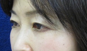 目の下のたるみ、目のくまでお悩みの方、切らずに完璧に解決します。TCB-R法　手術直後　症例写真