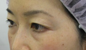 目の下のたるみ、目のくまでお悩みの方、切らずに完璧に解決します。TCB-R法　手術直後　症例写真