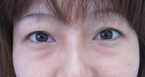 目の下のたるみ、目のくまでお悩みの方、切らずに完璧に解決します。TCB-R法　手術直後　症例写真