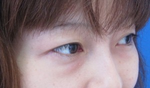 目の下のたるみ、目のくまでお悩みの方、切らずに完璧に解決します。TCB-R法　手術直後　症例写真