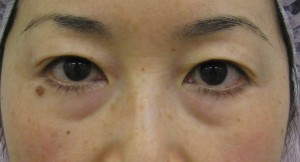 目の下のたるみ、目のくまでお悩みの方、切らずに完璧に解決します。TCB-R法　手術直後　症例写真