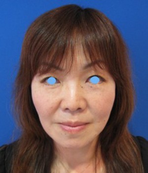 目の下のたるみ、目のくまでお悩みの方、切らずに完璧に解決します。TCB-R法　手術直後　症例写真