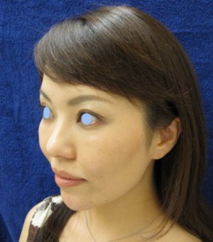 目の下のたるみ、目のくまでお悩みの方、切らずに完璧に解決します。TCB-R法　手術直後　症例写真