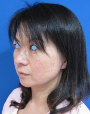 目の下のたるみ、目のくまでお悩みの方、切らずに完璧に解決します。TCB-R法　手術直後　症例写真