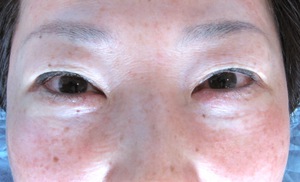 目の下のたるみ、目のくまでお悩みの方、切らずに完璧に解決します。TCB-R法　手術直後　症例写真
