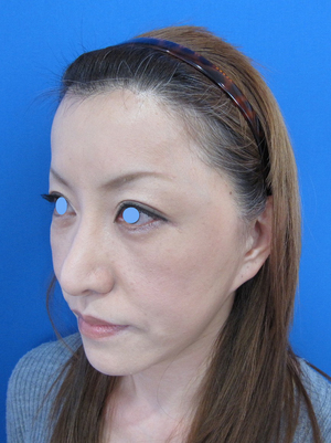 目の下のたるみ、目のくまでお悩みの方、切らずに完璧に解決します。TCB-R法　手術直後　症例写真