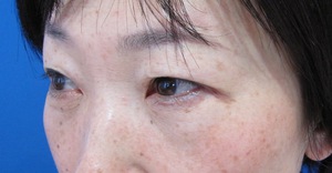 目の下のたるみ、目のくまでお悩みの方、切らずに完璧に解決します。TCB-R法　手術直後　症例写真
