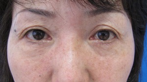 目の下のたるみ、目のくまでお悩みの方、切らずに完璧に解決します。TCB-R法　手術直後　症例写真