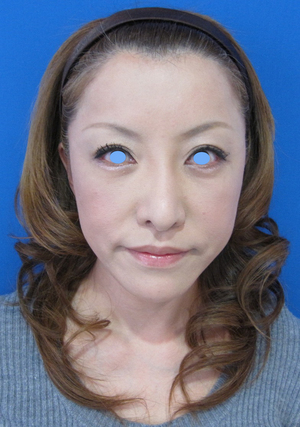 目の下のたるみ、目のくまでお悩みの方、切らずに完璧に解決します。TCB-R法　手術直後　症例写真