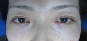 目の下のたるみ、目のくまでお悩みの方、切らずに完璧に解決します。TCB-R法　手術直後　症例写真