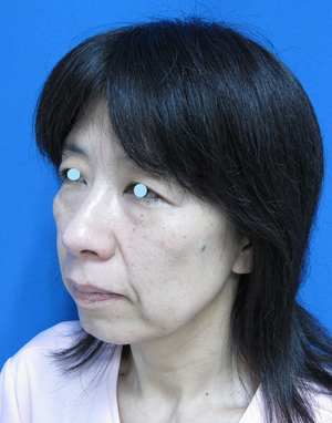 目の下のたるみ、目のくまでお悩みの方、切らずに完璧に解決します。TCB-R法　手術直後　症例写真