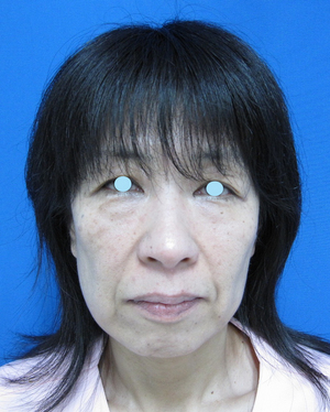 目の下のたるみ、目のくまでお悩みの方、切らずに完璧に解決します。TCB-R法　手術直後　症例写真