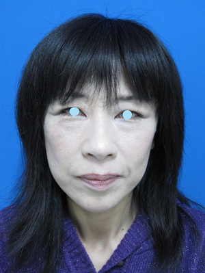 目の下のたるみ、目のくまでお悩みの方、切らずに完璧に解決します。TCB-R法　手術直後　症例写真