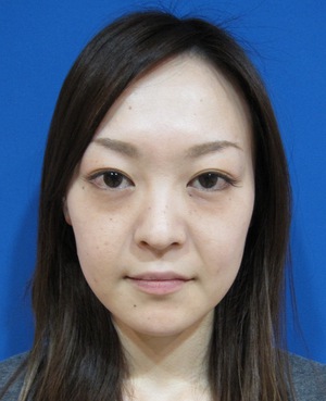目の下のたるみ、目のくまでお悩みの方、切らずに完璧に解決します。TCB-R法　手術直後　症例写真
