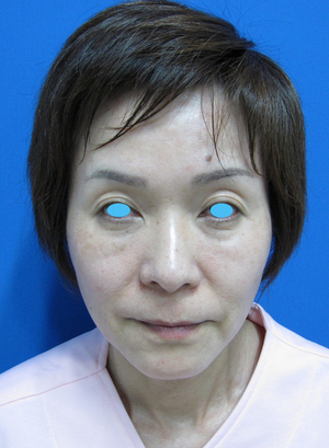 目の下のたるみ、目のくまでお悩みの方、切らずに完璧に解決します。TCB-R法　手術直後　症例写真