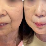 NO FACE SCAR LIFT monitor