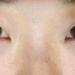 thumbnail__tcb-comparison-A–after