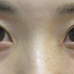thumbnail__tcb-comparison-A–before