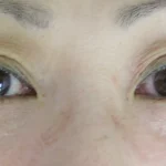 thumbnail__tcb-comparison-B–after
