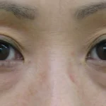 thumbnail__tcb-comparison-B–before