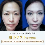 banner__sub-brow-lift