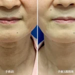 img-comparison__necklift–01