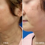 img-comparison__necklift–02