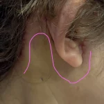 img-necklift-scar–01