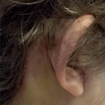 img-necklift-scar–02