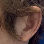 img-necklift-scar–03